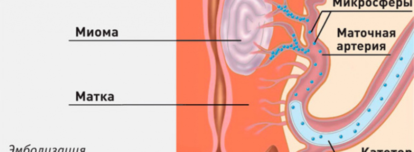 Эмболизация маточных артерий при миоме матки