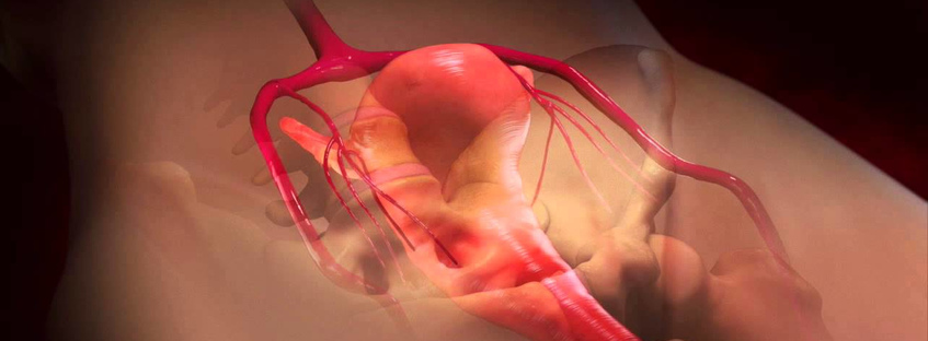 Миоматозный узел