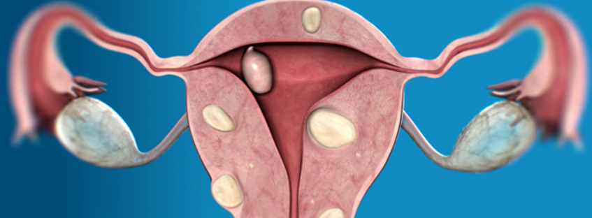 Множественная субсерозная миома матки